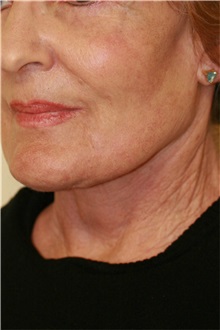 Neck Lift After Photo by Steve Laverson, MD, FACS; Rancho Santa Fe, CA - Case 38547