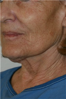 Neck Lift Before Photo by Steve Laverson, MD, FACS; Rancho Santa Fe, CA - Case 38547