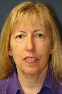 Facelift Before Photo by Steve Laverson, MD, FACS; San Diego, CA - Case 38575