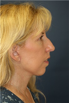 Facelift After Photo by Steve Laverson, MD, FACS; San Diego, CA - Case 38575