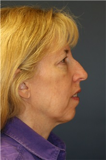 Facelift Before Photo by Steve Laverson, MD, FACS; San Diego, CA - Case 38575