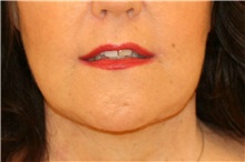 Lip Augmentation/Enhancement After Photo by Steve Laverson, MD, FACS; Rancho Santa Fe, CA - Case 38636