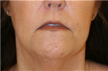 Lip Augmentation/Enhancement Before Photo by Steve Laverson, MD, FACS; Rancho Santa Fe, CA - Case 38636