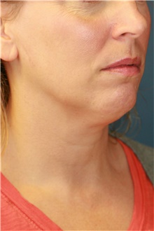 Liposuction Before Photo by Steve Laverson, MD, FACS; San Diego, CA - Case 38644