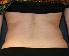 Liposuction After Photo by Steve Laverson, MD; San Diego, CA - Case 38655