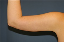 Liposuction After Photo by Steve Laverson, MD, FACS; San Diego, CA - Case 38656