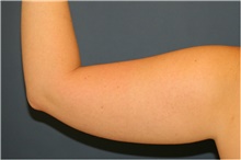 Liposuction Before Photo by Steve Laverson, MD, FACS; San Diego, CA - Case 38656