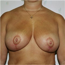 Breast Reduction After Photo by Steve Laverson, MD, FACS; Rancho Santa Fe, CA - Case 38670