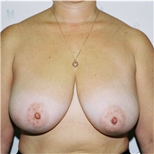 Breast Reduction Before Photo by Steve Laverson, MD, FACS; San Diego, CA - Case 38670