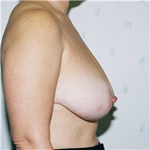 Breast Reduction Before Photo by Steve Laverson, MD, FACS; Rancho Santa Fe, CA - Case 38670