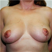 Breast Reduction After Photo by Steve Laverson, MD, FACS; Rancho Santa Fe, CA - Case 38680