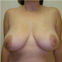 Breast Reduction Before Photo by Steve Laverson, MD, FACS; San Diego, CA - Case 38680