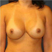 Breast Implant Revision After Photo by Steve Laverson, MD, FACS; Rancho Santa Fe, CA - Case 38685