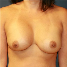 Breast Implant Revision Before Photo by Steve Laverson, MD, FACS; Rancho Santa Fe, CA - Case 38685