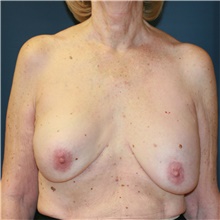 Breast Implant Revision Before Photo by Steve Laverson, MD, FACS; Rancho Santa Fe, CA - Case 38694