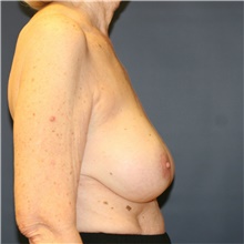 Breast Implant Revision After Photo by Steve Laverson, MD, FACS; Rancho Santa Fe, CA - Case 38694