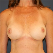 Breast Implant Revision After Photo by Steve Laverson, MD, FACS; Rancho Santa Fe, CA - Case 38720