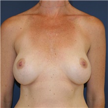 Breast Implant Revision Before Photo by Steve Laverson, MD, FACS; Rancho Santa Fe, CA - Case 38720