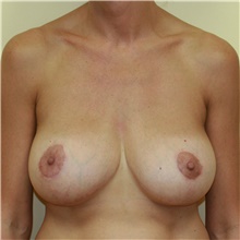 Breast Implant Revision After Photo by Steve Laverson, MD, FACS; Rancho Santa Fe, CA - Case 38724
