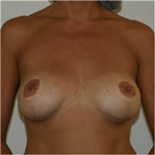 Breast Implant Revision Before Photo by Steve Laverson, MD, FACS; Rancho Santa Fe, CA - Case 38724
