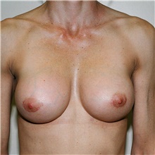 Breast Implant Revision After Photo by Steve Laverson, MD, FACS; Rancho Santa Fe, CA - Case 38738