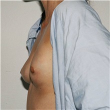 Breast Implant Revision Before Photo by Steve Laverson, MD, FACS; Rancho Santa Fe, CA - Case 38738