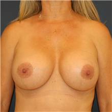 Breast Implant Revision After Photo by Steve Laverson, MD, FACS; Rancho Santa Fe, CA - Case 38739