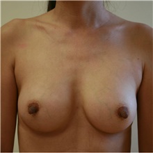 Breast Implant Revision After Photo by Steve Laverson, MD, FACS; Rancho Santa Fe, CA - Case 38783