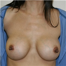 Breast Implant Revision Before Photo by Steve Laverson, MD, FACS; Rancho Santa Fe, CA - Case 38783