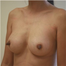 Breast Implant Revision After Photo by Steve Laverson, MD, FACS; Rancho Santa Fe, CA - Case 38783