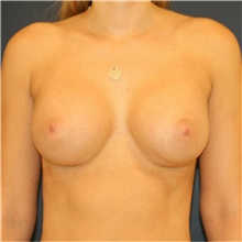 Breast Augmentation After Photo by Steve Laverson, MD; San Diego, CA - Case 38804