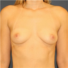 Breast Augmentation Before Photo by Steve Laverson, MD; San Diego, CA - Case 38804