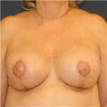 Breast Lift After Photo by Steve Laverson, MD, FACS; San Diego, CA - Case 38805