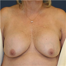 Breast Lift Before Photo by Steve Laverson, MD, FACS; San Diego, CA - Case 38805