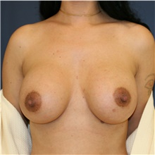 Breast Augmentation After Photo by Steve Laverson, MD, FACS; Rancho Santa Fe, CA - Case 38811