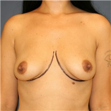 Breast Augmentation Before Photo by Steve Laverson, MD, FACS; Rancho Santa Fe, CA - Case 38811