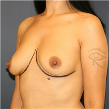 Breast Augmentation Before Photo by Steve Laverson, MD, FACS; Rancho Santa Fe, CA - Case 38811