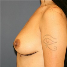 Breast Augmentation Before Photo by Steve Laverson, MD, FACS; Rancho Santa Fe, CA - Case 38811