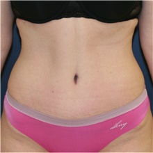 Tummy Tuck After Photo by Steve Laverson, MD, FACS; Rancho Santa Fe, CA - Case 38819