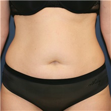 Tummy Tuck Before Photo by Steve Laverson, MD, FACS; Rancho Santa Fe, CA - Case 38819