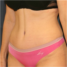 Tummy Tuck After Photo by Steve Laverson, MD, FACS; Rancho Santa Fe, CA - Case 38819