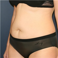 Tummy Tuck Before Photo by Steve Laverson, MD, FACS; Rancho Santa Fe, CA - Case 38819