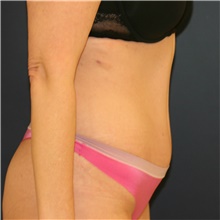 Tummy Tuck After Photo by Steve Laverson, MD, FACS; Rancho Santa Fe, CA - Case 38819