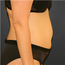 Tummy Tuck Before Photo by Steve Laverson, MD, FACS; Rancho Santa Fe, CA - Case 38819