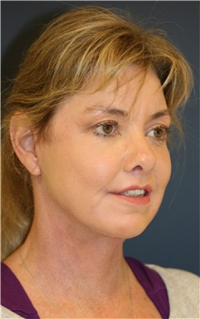 Facelift After Photo by Steve Laverson, MD, FACS; San Diego, CA - Case 38820