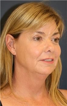 Facelift Before Photo by Steve Laverson, MD, FACS; San Diego, CA - Case 38820