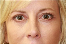 Eyelid Surgery After Photo by Steve Laverson, MD, FACS; Rancho Santa Fe, CA - Case 38854