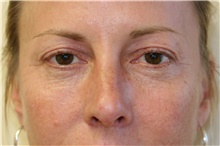 Eyelid Surgery Before Photo by Steve Laverson, MD, FACS; Rancho Santa Fe, CA - Case 38854