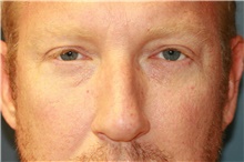 Eyelid Surgery After Photo by Steve Laverson, MD, FACS; Rancho Santa Fe, CA - Case 38893