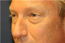 Eyelid Surgery Before Photo by Steve Laverson, MD, FACS; Rancho Santa Fe, CA - Case 38893